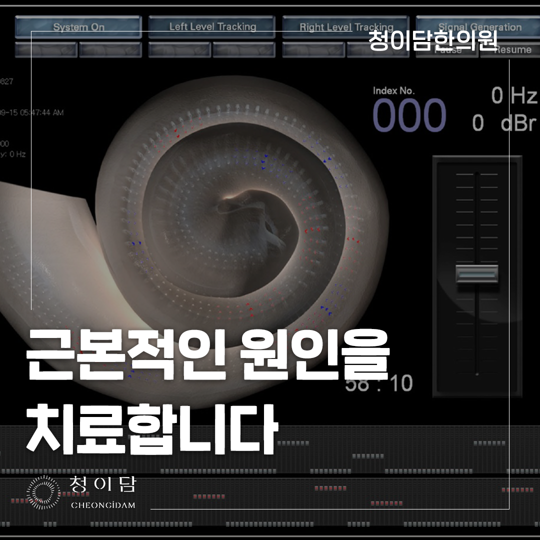 돌발성 난청 약 복용 전후 검사로 확인해야 할 청력 변화